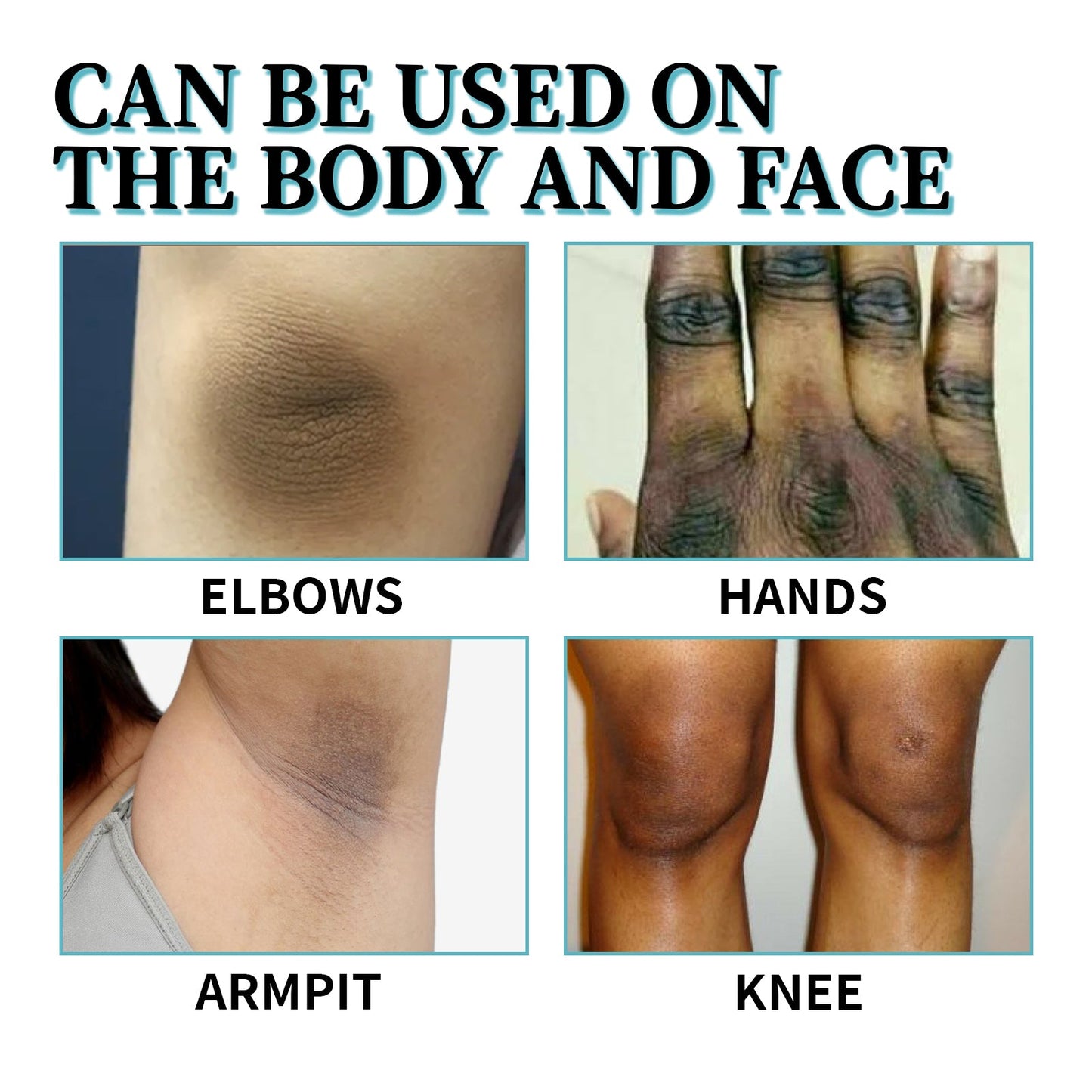 Acanthosis Nigricans Therapy Cream, Repair Dull Skin Lightening Joint Black Moisturizing Whitening Skin Care Cream