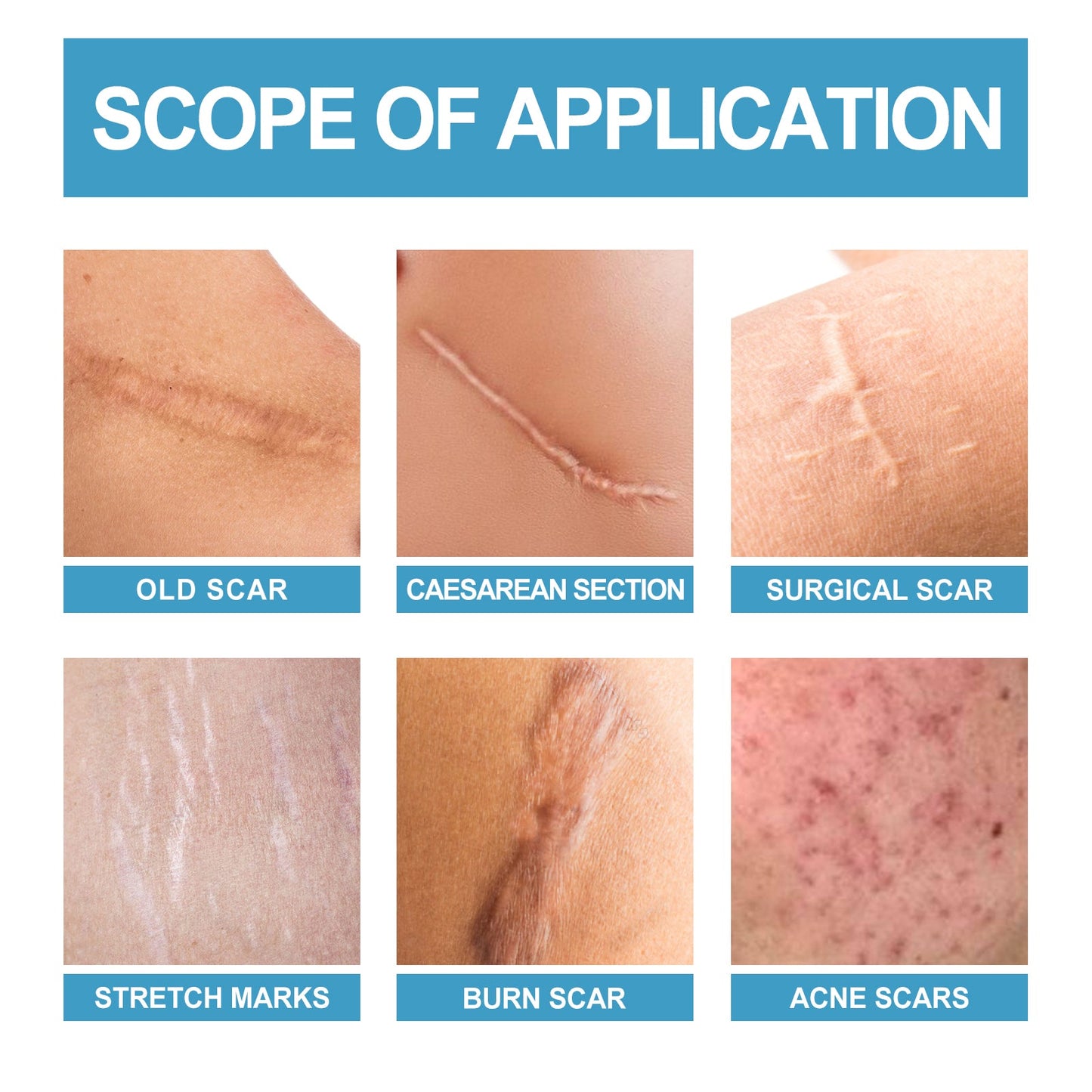 Scar Repair Serum Lightens Post-Pregnancy Scar Repair And Smoothes Body Skin